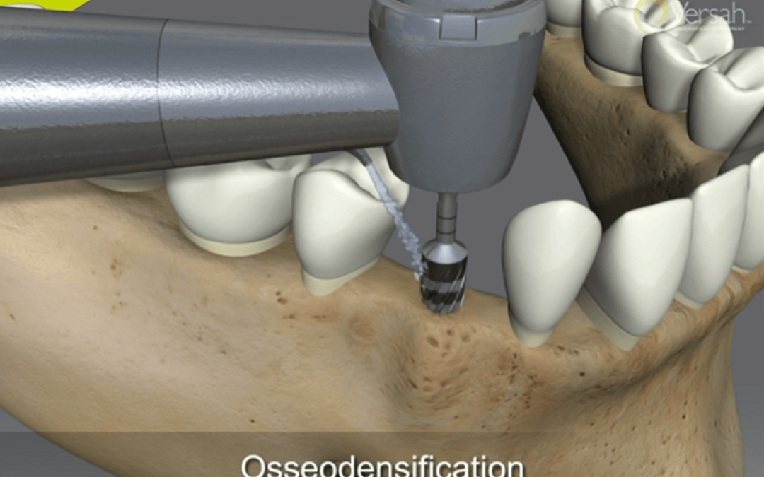 Osseodensification