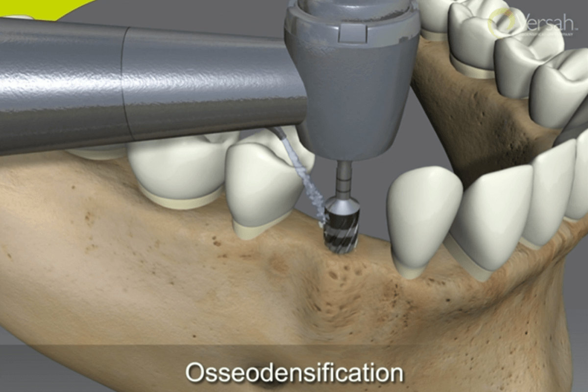 Osseodensification