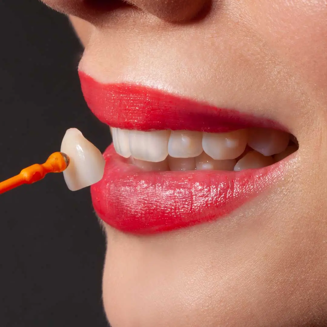 Minimal Prep Veneers aus Keramik für ein natürliches und ästhetisches Lächeln