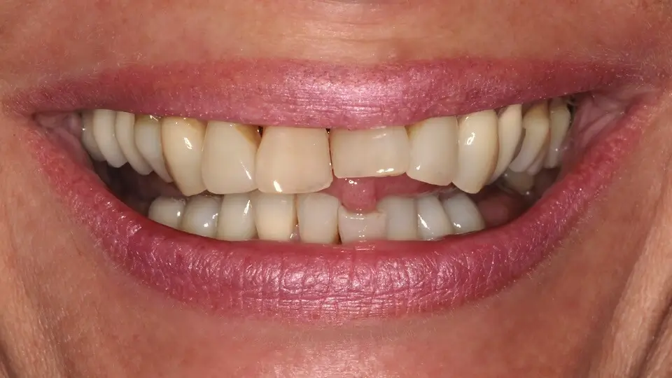 Clear Aligner Therapie