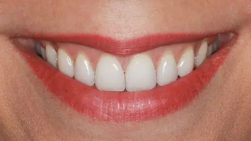 Clear Aligner Therapie 12