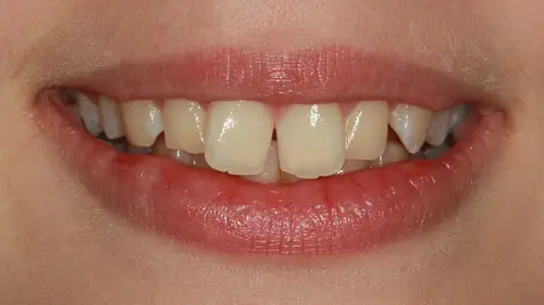 Clear Aligner Therapie 19