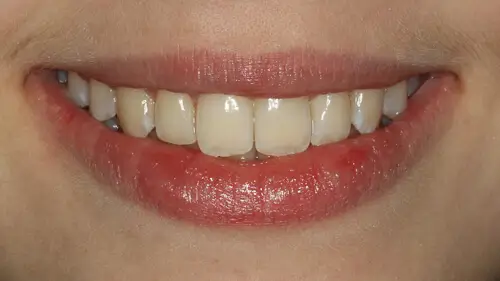 Clear Aligner Therapie 20