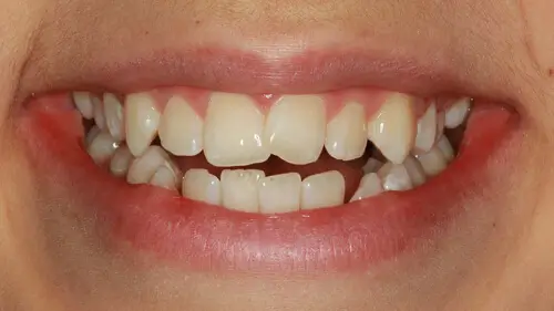 Clear Aligner Therapie 21