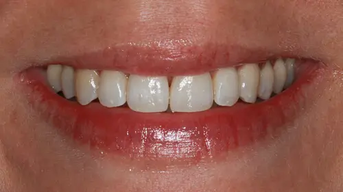 Clear Aligner Therapie 28