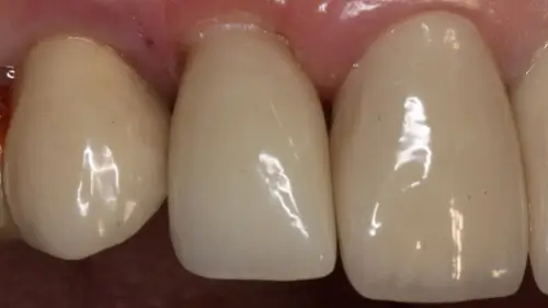 Keramikimplantate 32