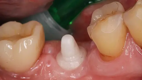 Keramikimplantate 41