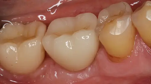 Keramikimplantate 42
