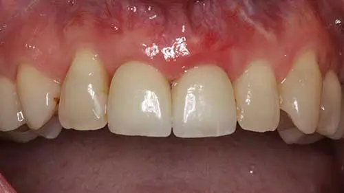 Keramikimplantate 48