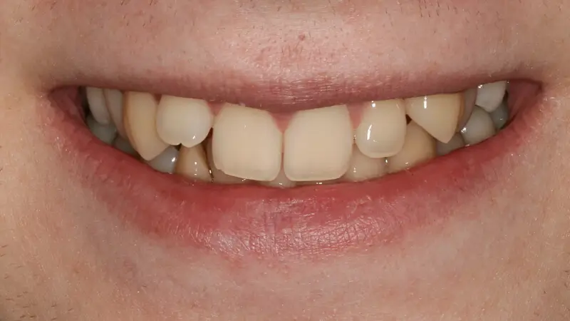 Clear Aligner Therapie 5