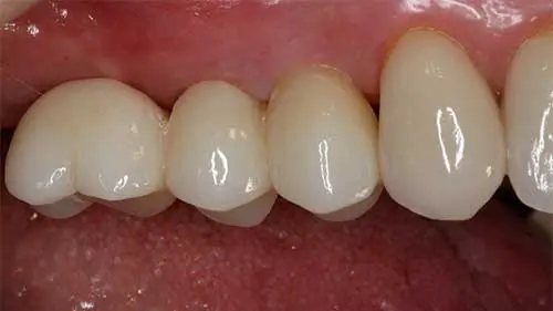 Keramikimplantate 52