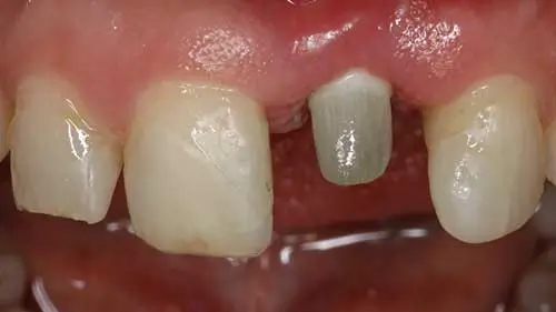 Keramikimplantate 53