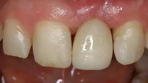 Keramikimplantate 54
