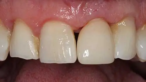 Keramikimplantate 58