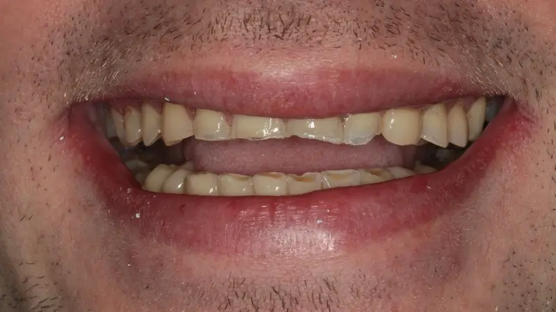 Kronen und Veneers 59