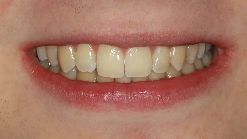 Clear Aligner Therapie 6