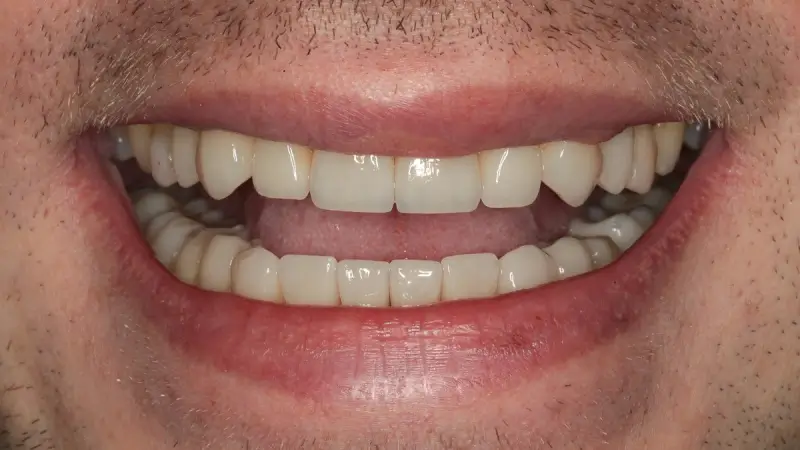 Kronen und Veneers 60