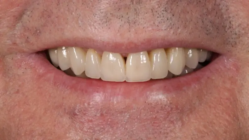 Kronen und Veneers 68