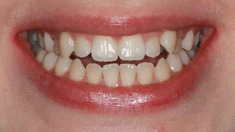 Clear Aligner Therapie 7