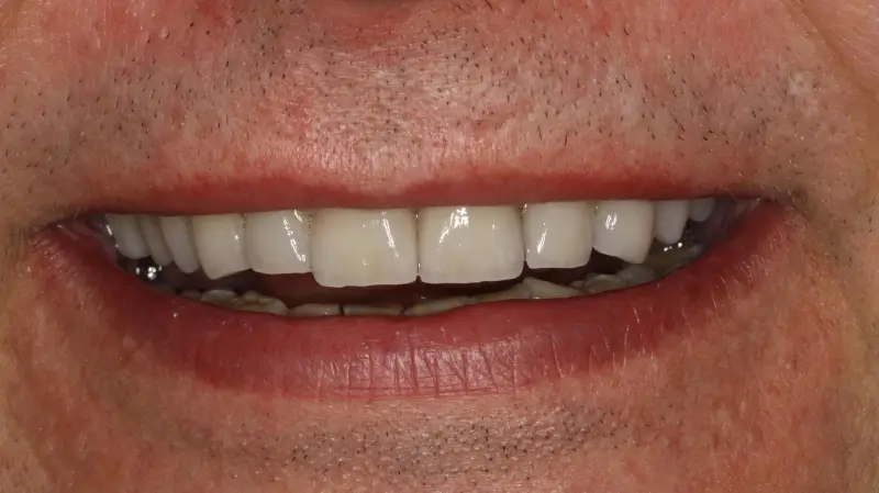 Kronen und Veneers 78
