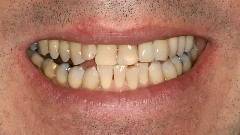 Kronen und Veneers 79