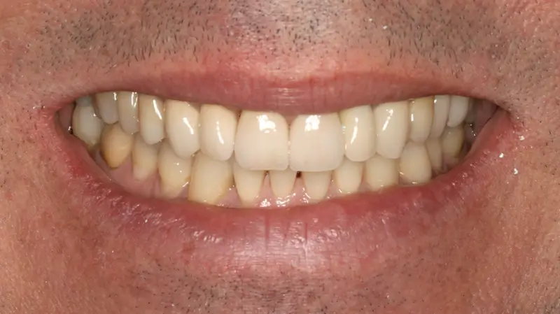 Kronen und Veneers 80