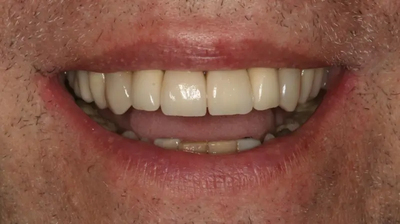 Kronen und Veneers 82