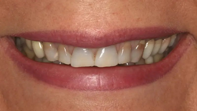 Kronen und Veneers 69