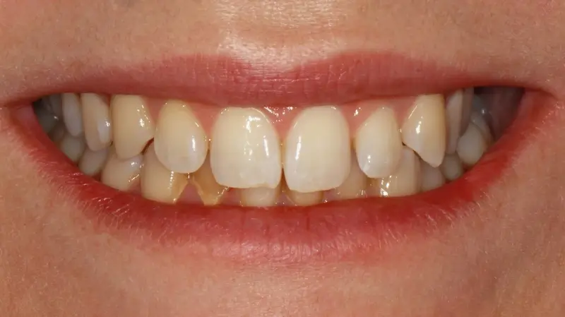 Kronen und Veneers 73