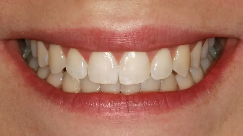 Kronen und Veneers 74